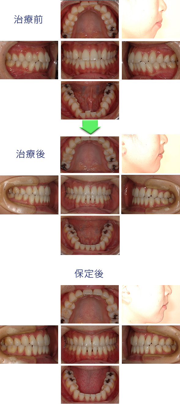 矯正歯科治療の実際の流れ 大人編 佐久市矯正歯科なら コスモ歯科矯正クリニック